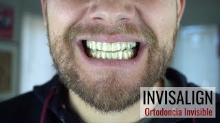 Mi experiencia con Invisalign (ORTODONCIA INVISIBLE)