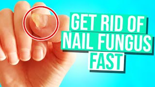 How To Get Rid of Nail Fungus in 2024