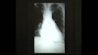 Cardiac masses  36 e