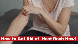 Easy and Effective: How to Get Rid of Heat Rash Now!
