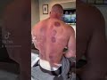 Cupping to increase blood circulation!