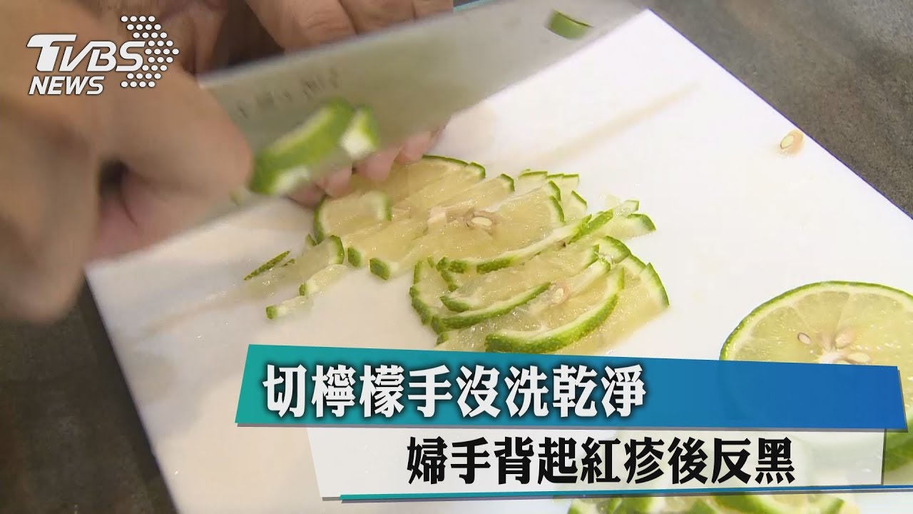 切檸檬手沒洗乾淨 婦手背起紅疹後反黑