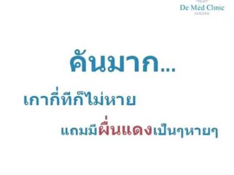 วิธีการที่สามารถรักษา neurodermatitis ธรรมชาติบำบัดสำหรับ neurodermatitis