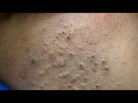 Deep Facial Cleansing | Acne Treatment & Blackhead Removal Tips