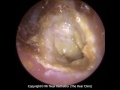 194: Eardrum about to 'EXPLODE' after Blocked Ear Wax Removal using Endoscopic Ear Microsuction