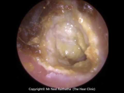 194: Eardrum about to 'EXPLODE' after Blocked Ear Wax Removal using Endoscopic Ear Microsuction