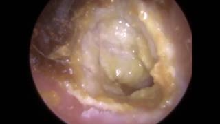 194: Eardrum about to &#39;EXPLODE&#39; after Blocked Ear Wax Removal using Endoscopic Ear Microsuction