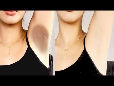 How To Lighten Your Dark Underarms Permanently - 100% Effective Home Remedy For Dark Body Parts Video