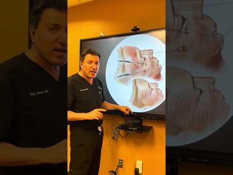 GLIDELIFT - LATEST FACELIFT TECHNIQUE BY DR OZAN SOZER
