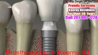 preview picture of video 'Prosthodontist in Kearny NJ-Smile Design Specialist-Call 201-991-1228'
