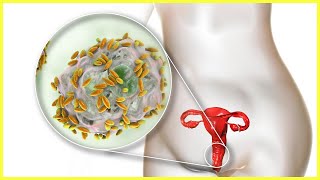 Scheidenpilz - Symptome, Ursachen & Behandlung ✅