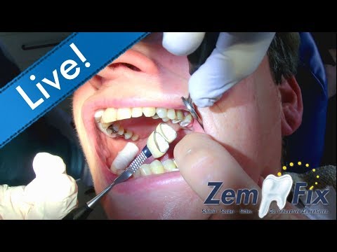 Dentist life made easy! Inserting 2 metal-ceramic crowns at once with ZemFix®