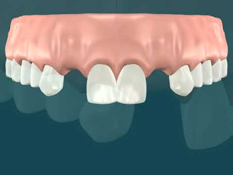 Dental Video for Root Tipping for Implants - The Tooth