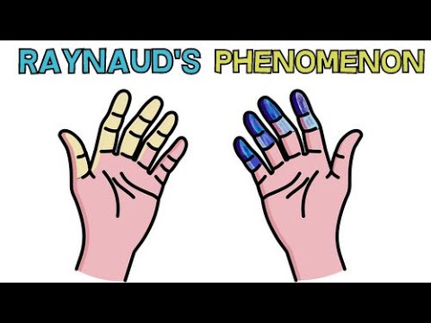 RAYNAUDS SYNDROME | CAUSE, APPEARANCE, DIAGNOSIS AND TREATMENT - RAYNAUDS PHENOMENON