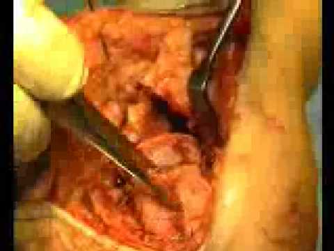Calcaneal fracture ORIF Video