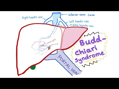 Budd-Chiari syndrome (Definition, causes, pathophysiology, Diagnosis & Treatment)