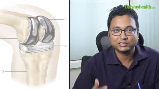 What is knee replacement surgery?