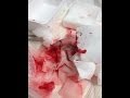 Getting Stitches Taking Out