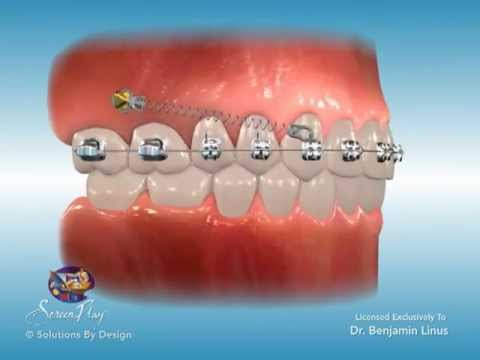 Orthodontic Marketing & Patient Education: Temporary...