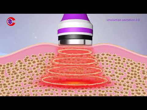 How Ultrasonic Cavitation Work? How Ultrasonic Cavitation Remove Fat? What Is  Cavitation Machine?