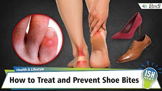 How to Treat and Prevent Shoe Bites