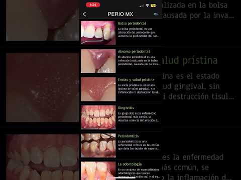 Perio Mx video thumbnail