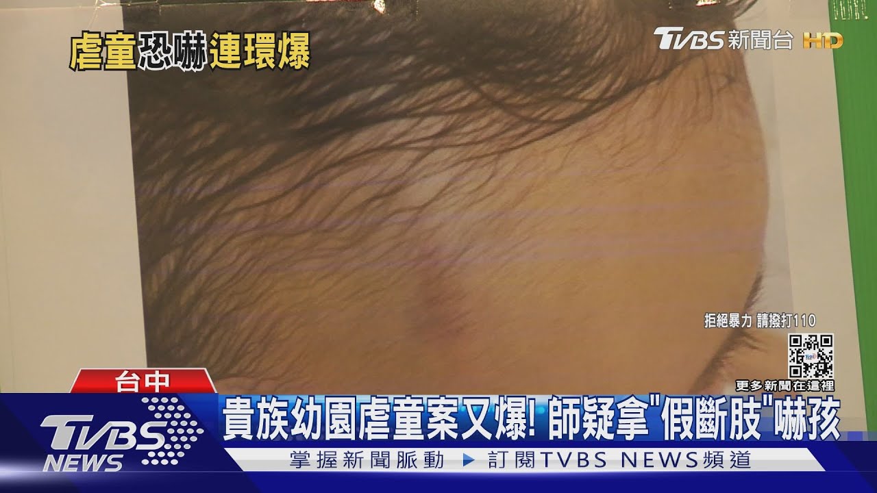 貴族幼園虐童案又爆！師疑拿「假斷肢」嚇孩