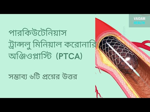 পারকিউটেনিয়াস ট্রান্সলুমিনাল করোনারি অ্যাঞ্জিওপ্লাস্টি- ৬ টি প্রায়শই জিজ্ঞাসিত প্রশ্ন