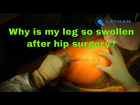 Why is my leg so swollen after hip surgery?