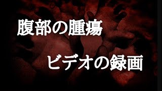 【意味が分かると怖い話】腹部の腫瘍とビデオの録画