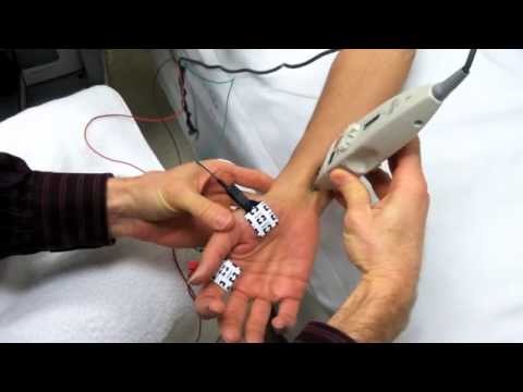 Median Motor Nerve Conduction Study