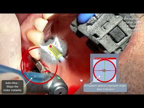 Lawrence Obstfeld, Image Navigation - Robotic dental implant navigation with autostop | LSI USA '26