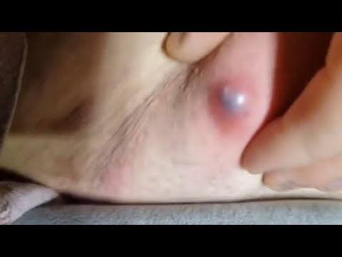 Popping huge blackheads and Giant Pimples - Best Pimple Popping Videos #113