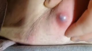 Popping huge blackheads and Giant Pimples - Best Pimple Popping Videos #113