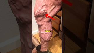 How to get rid of varicose veins.. #shorts