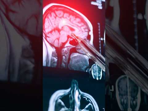 Study: 1 in 4 NFL players who died in 5-year span had CTE