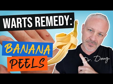Warts Remedy: Banana Peels!  | Dr. Doug