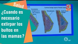 ¿Cuándo es necesario extirpar los bultos en las mamas | Salud