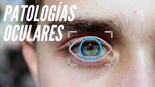 Patologías Oftalmológicas - Visióon Oftalmólogos