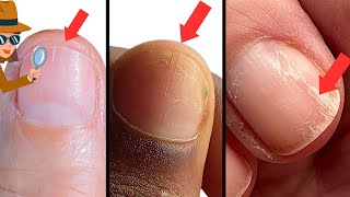 How to Survive Splitting Nails. Causes & Remedies.