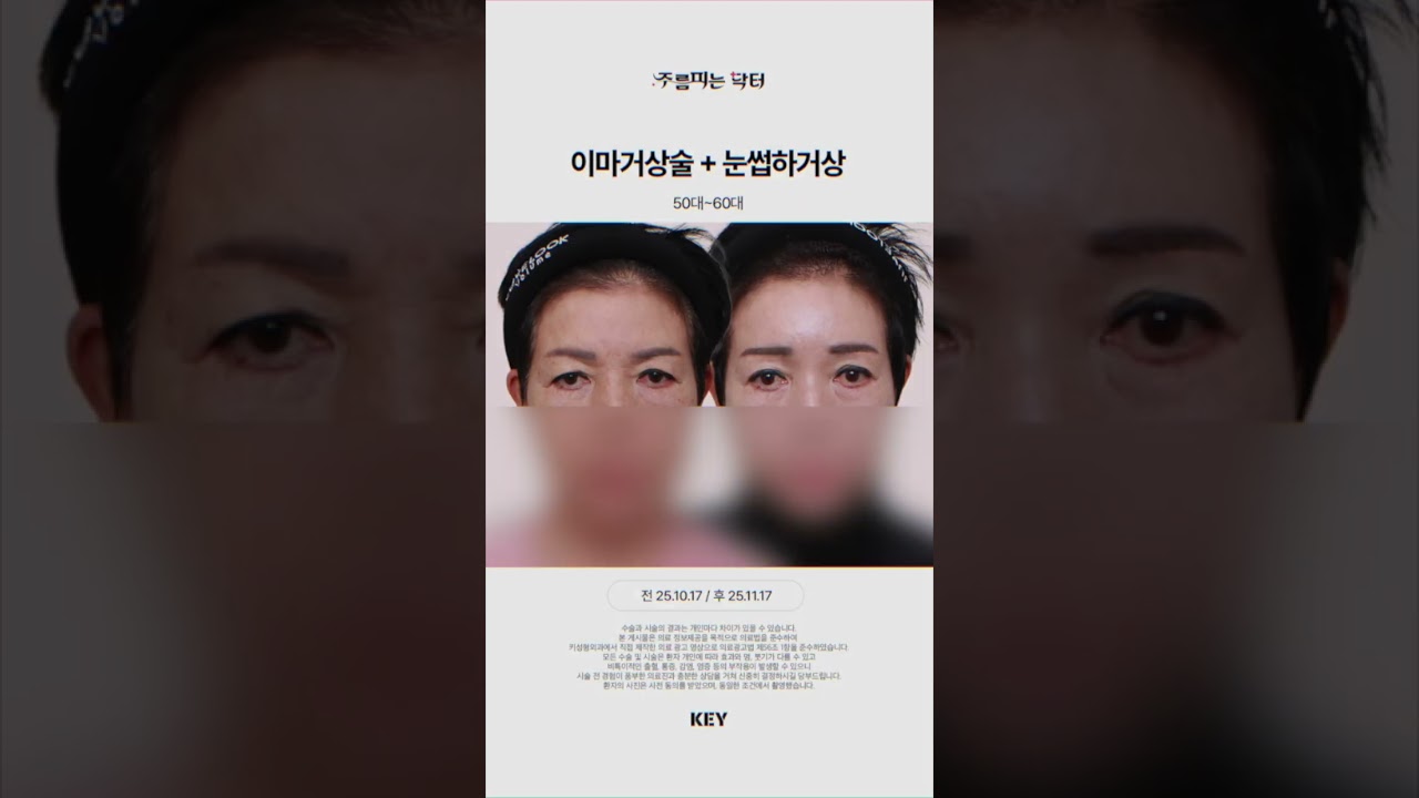 5060의 이마거상 + 눈썹하거상