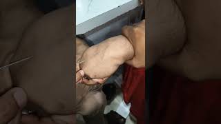 iv cannula motivation video, iv cannula, vigo kaise lgaye? #shorts #viral #vigo