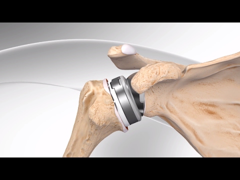Reverse Total Shoulder Replacement with Univers Revers™ System
