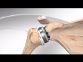 Reverse Total Shoulder Replacement With Univers Revers System