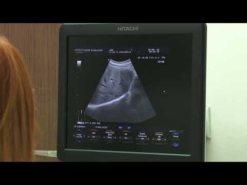 Alarmantan broj umrlih od bolesti srca i krvnih sudova