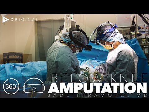 Principles of Amputation - Physiopedia