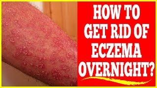 How to Get Rid Of Eczema Overnight - Easy Home Remedies To Get Rid Of Eczema Overnight