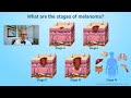 What are the stages of melanoma?