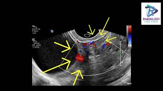 Twisted ovarian vascular pedicle#Damayanthi#Chandana