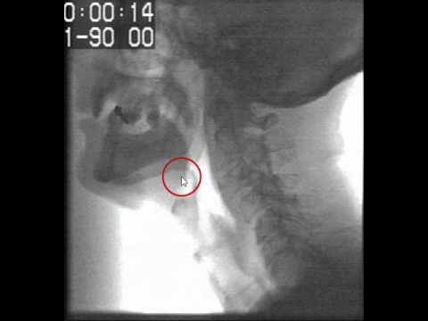 How to Identify Anatomical Landmarks on Videofluorscopy